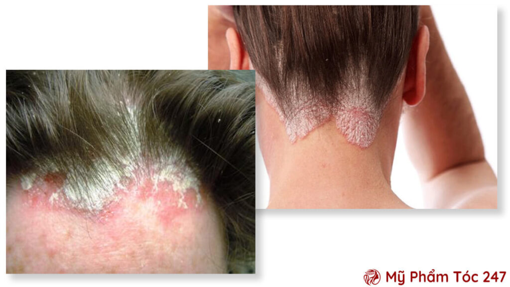 Hậu quả khôn lường của việc sử dụng phải mỹ phẩm tóc giả.